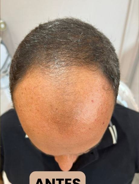Antes do transplante capilar