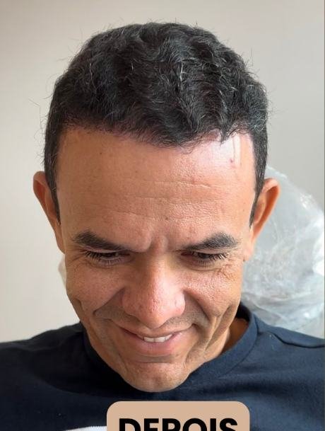Depois do transplante capilar