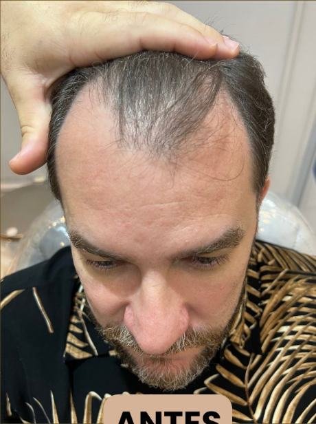 Antes do transplante capilar