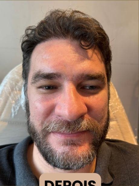 Depois do transplante capilar