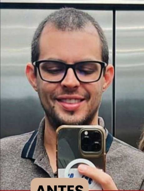Antes do transplante capilar