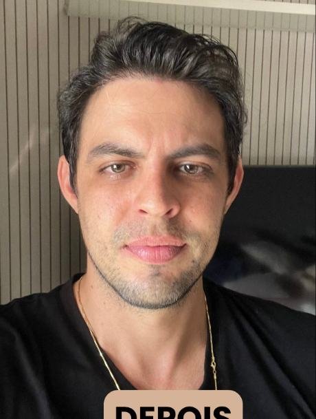 Depois do transplante capilar