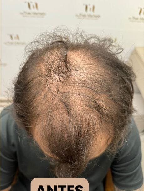 Antes do transplante capilar