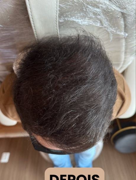 Depois do transplante capilar