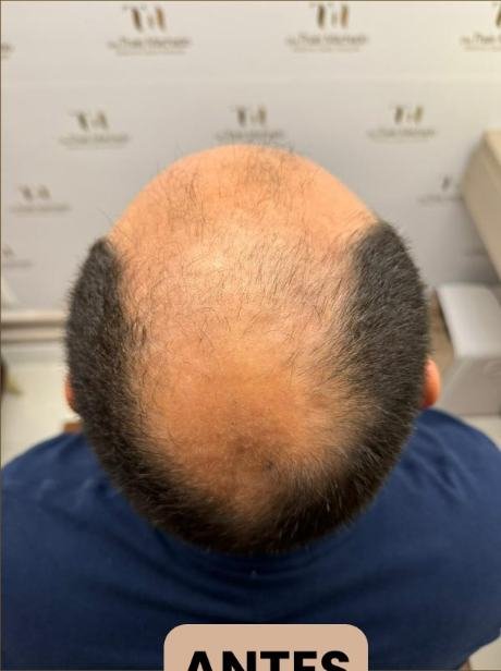 Antes do transplante capilar