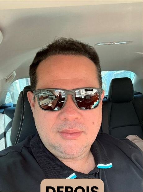 Depois do transplante capilar