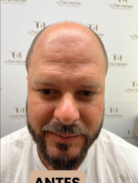 Antes do transplante capilar
