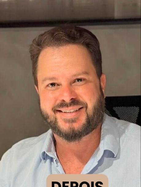Depois do transplante capilar