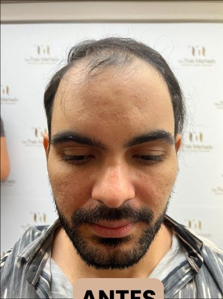 Antes do transplante capilar
