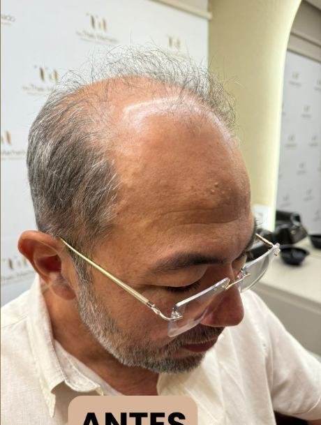 Antes do transplante capilar