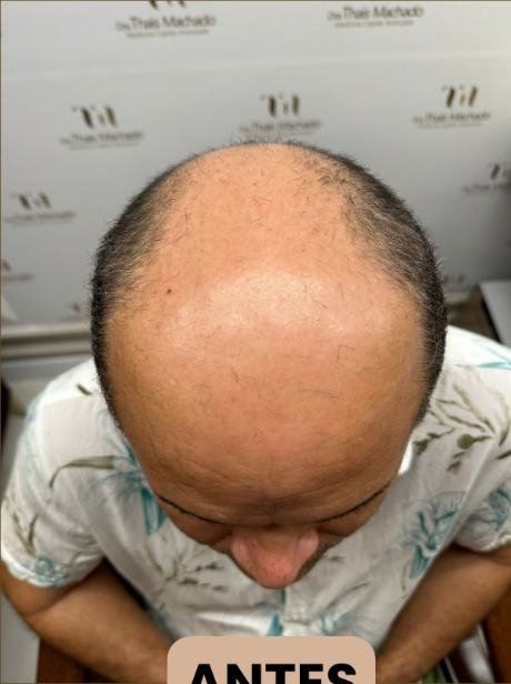 Antes do transplante capilar