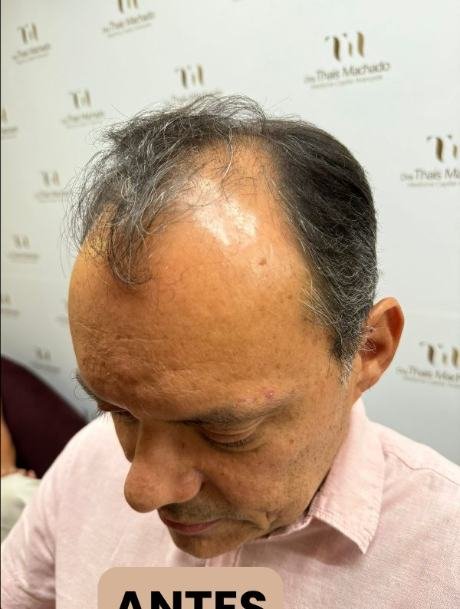 Antes do transplante capilar