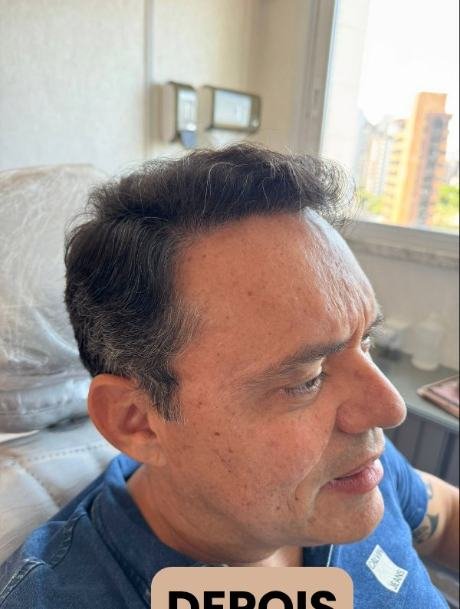 Depois do transplante capilar