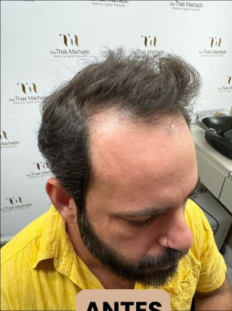 Antes do transplante capilar