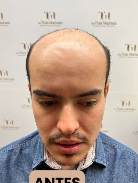 Antes do transplante capilar