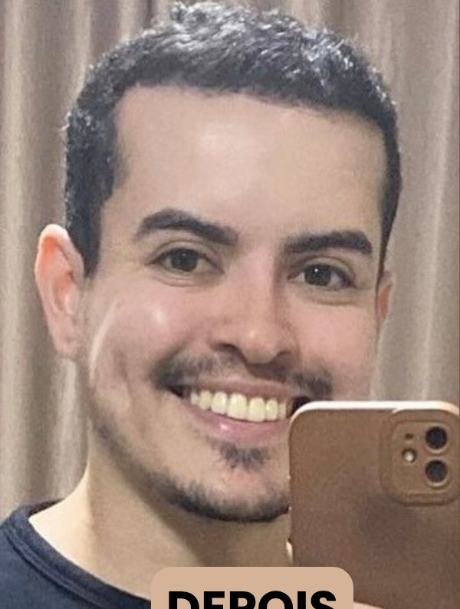 Depois do transplante capilar
