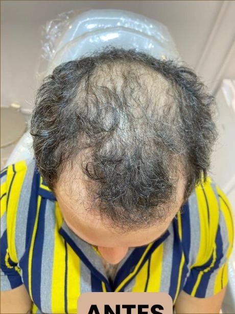 Antes do transplante capilar
