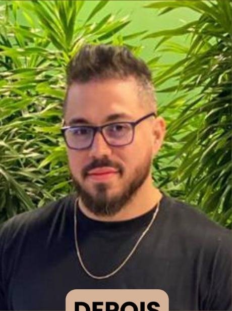 Depois do transplante capilar