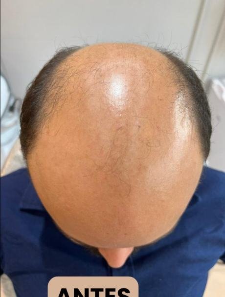 Antes do transplante capilar