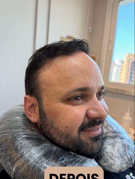 Depois do transplante capilar