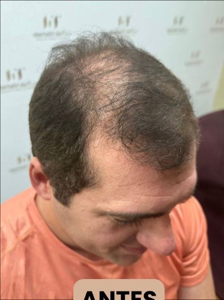 Antes do transplante capilar