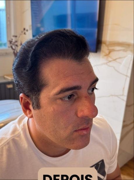 Depois do transplante capilar