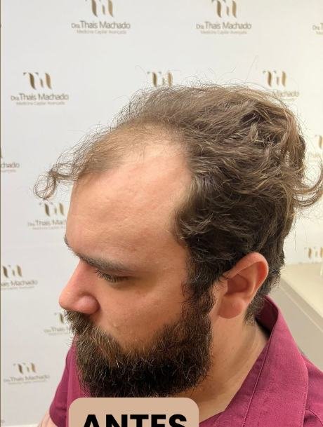 Antes do transplante capilar