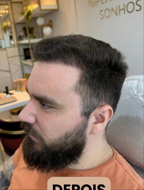 Depois do transplante capilar