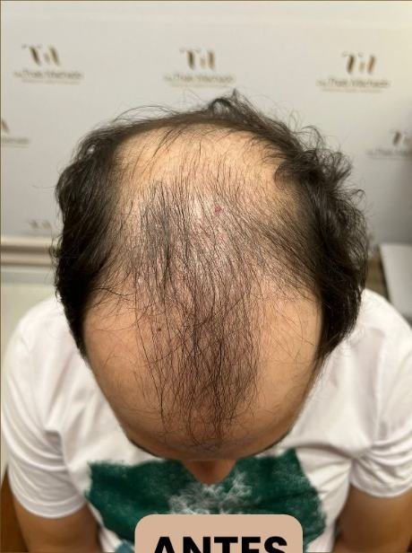 Antes do transplante capilar