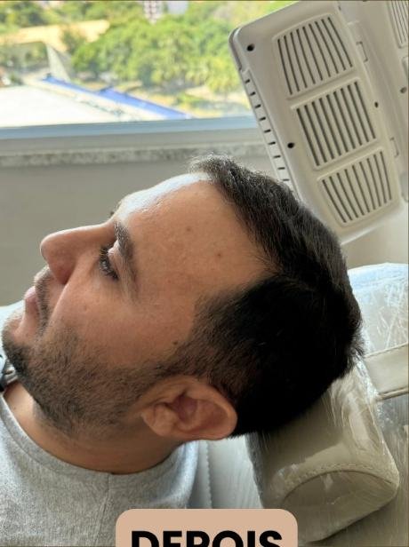 Depois do transplante capilar