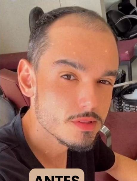 Antes do transplante capilar