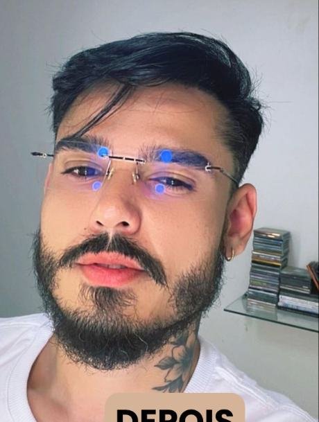 Depois do transplante capilar