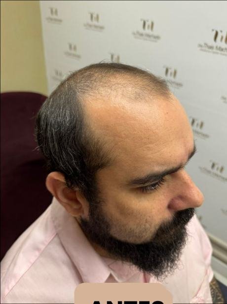 Antes do transplante capilar