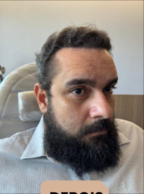 Depois do transplante capilar