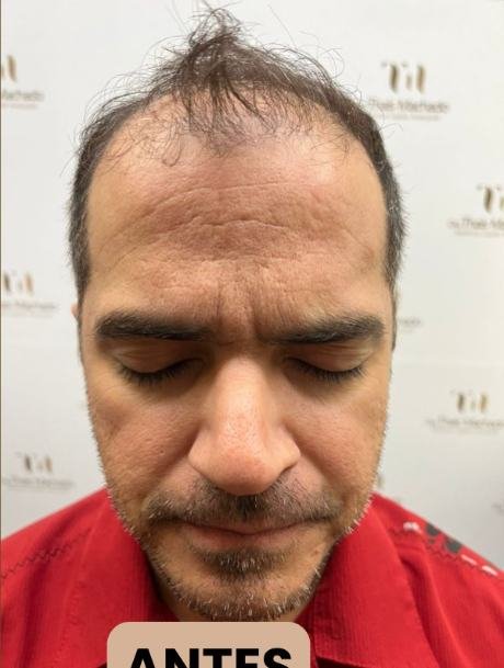 Antes do transplante capilar