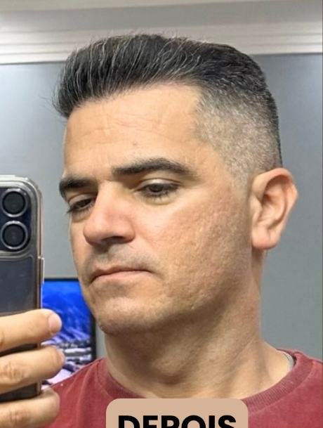 Depois do transplante capilar