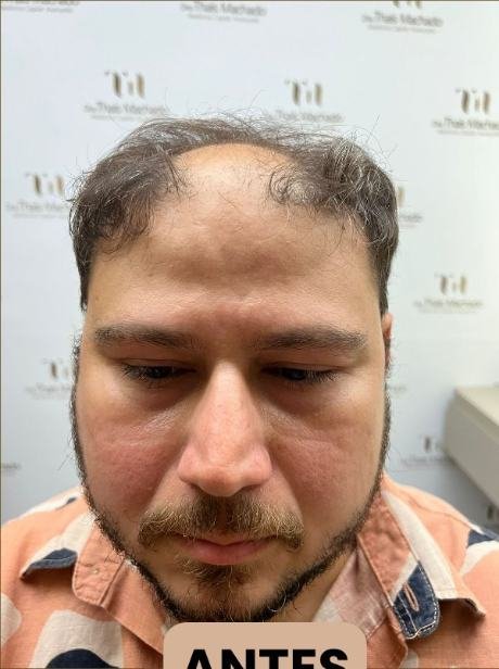 Antes do transplante capilar