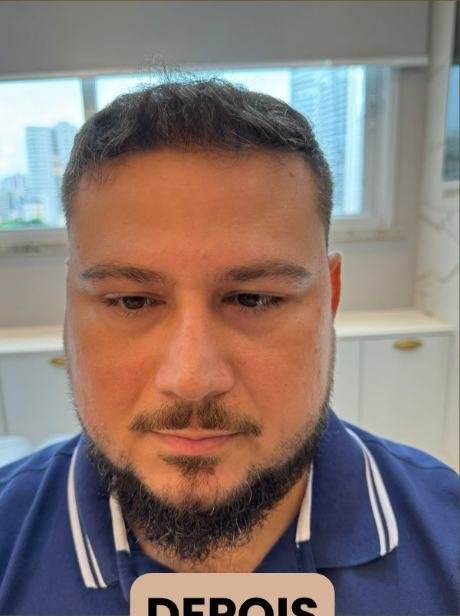 Depois do transplante capilar