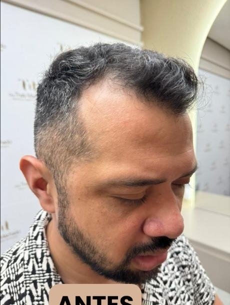 Antes do transplante capilar