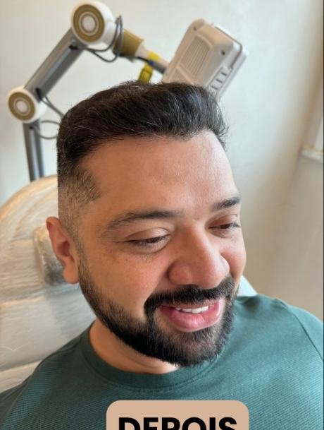 Depois do transplante capilar