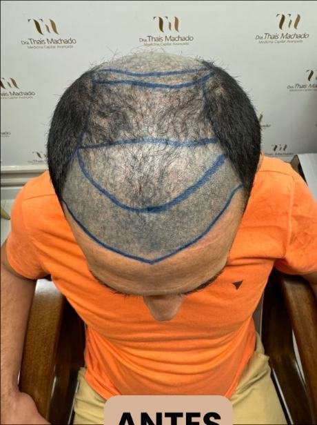 Antes do transplante capilar