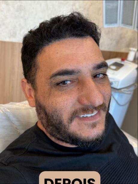 Depois do transplante capilar