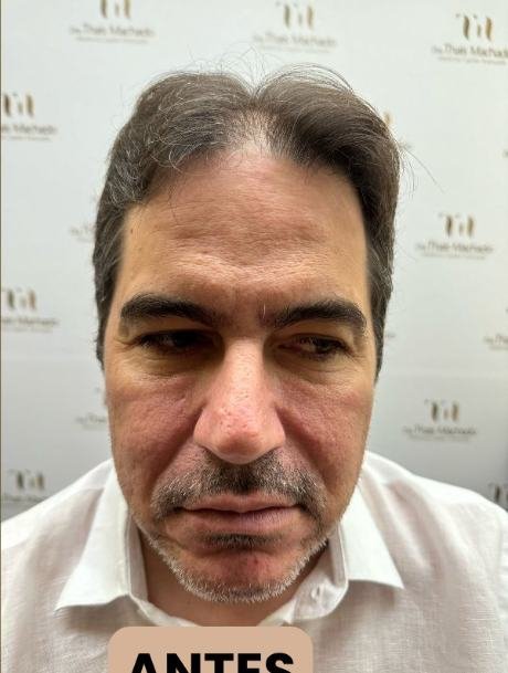 Antes do transplante capilar