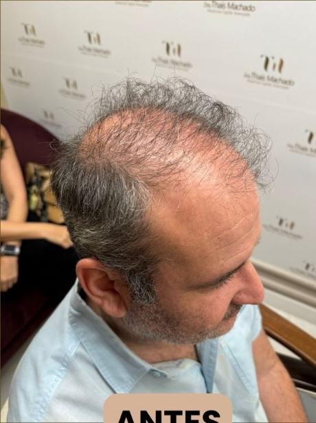 Antes do transplante capilar