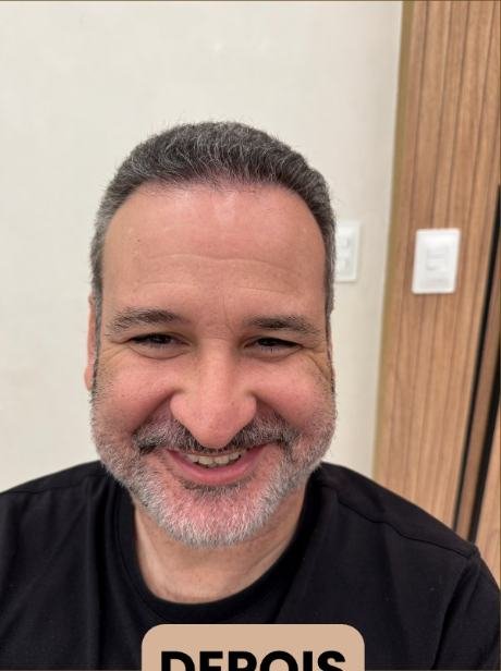 Depois do transplante capilar