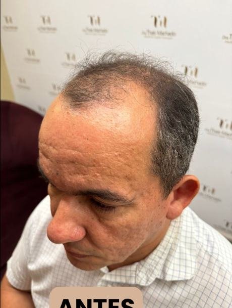 Antes do transplante capilar