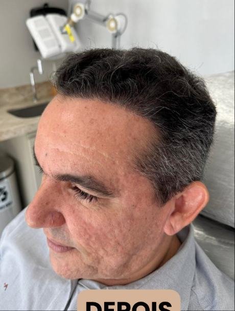 Depois do transplante capilar