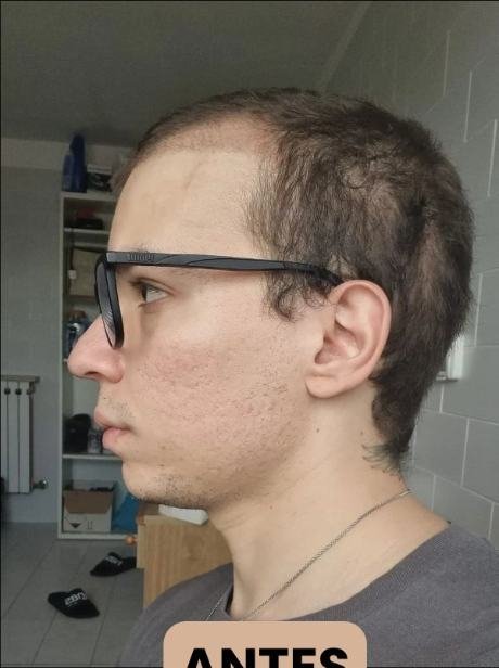 Antes do transplante capilar