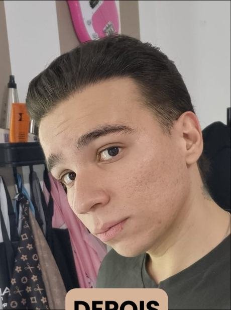 Depois do transplante capilar