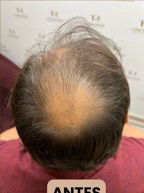 Antes do transplante capilar